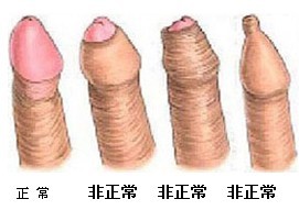 包皮过长怎么清洗才干净?